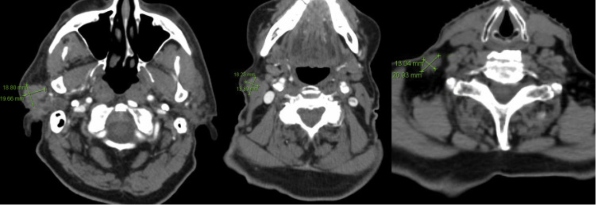 single-fraction radiation therapy